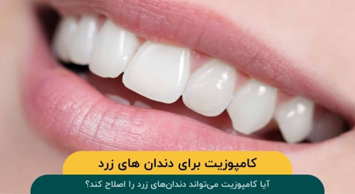 آیا-کامپوزیت-می-تواند-دندان-های-زرد-را-اصلاح-کند